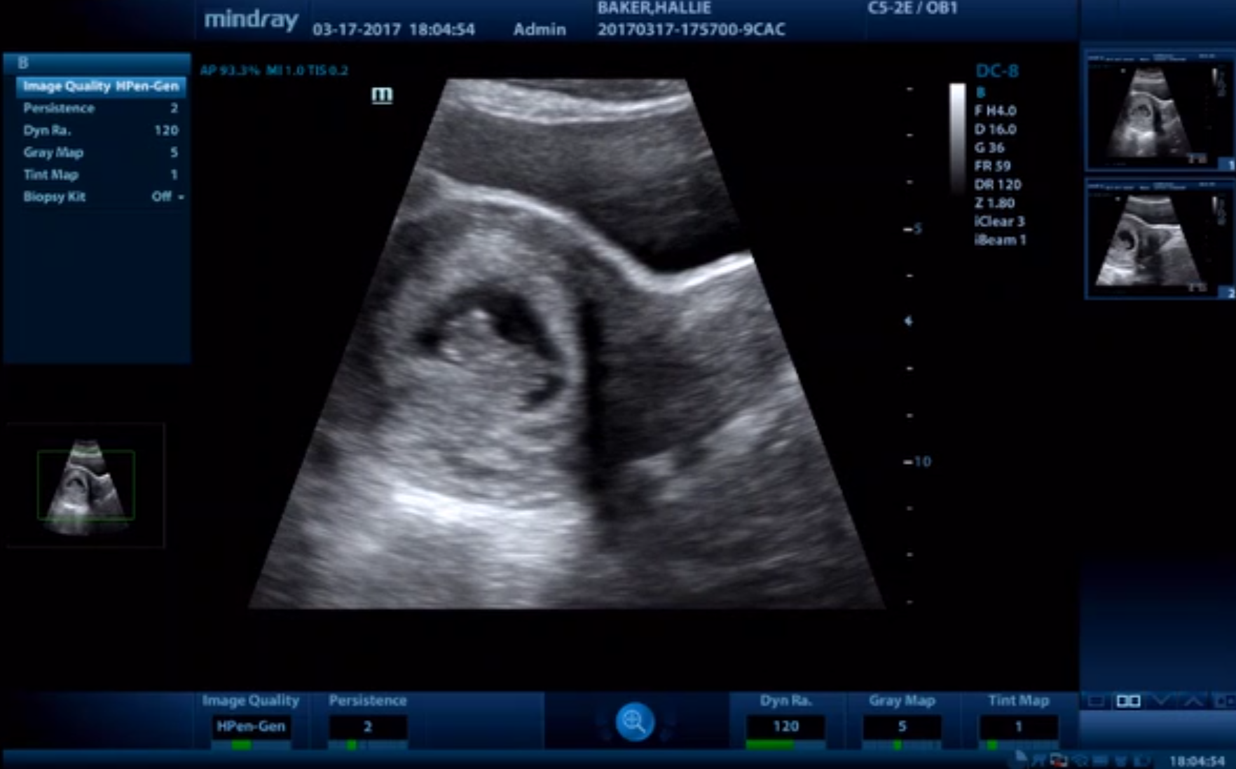 Ultrasound video showing baby